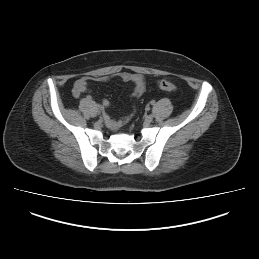 File:Ascending retrocecal appendicitis with liver abscesses (Radiopaedia 60066-67615 Axial non-contrast 66).jpg