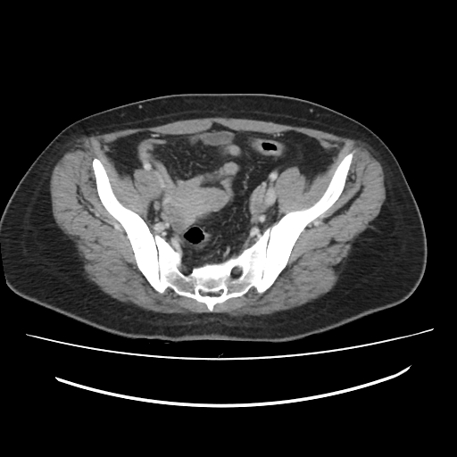 File:Ascending retrocecal appendicitis with liver abscesses (Radiopaedia 60066-67615 B 73).jpg