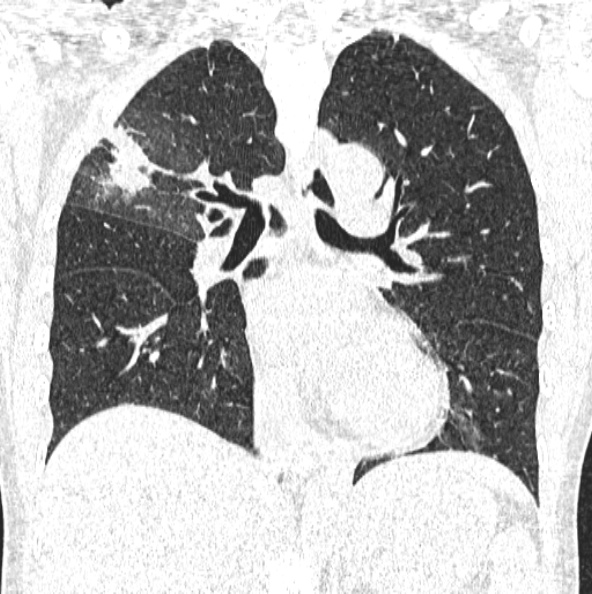 File:Aspergilloma (Radiopaedia 26223-26347 Coronal lung window 29).jpg