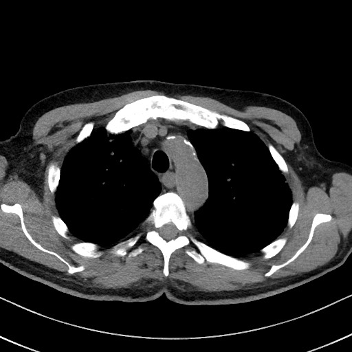 Aspergilloma on background pulmonary fibrosis (Radiopaedia 60942-68757 Axial non-contrast 17).jpg