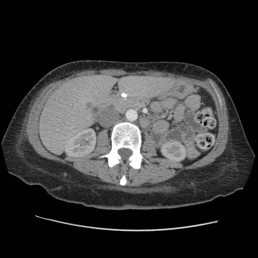File:Aspiration pneumonia secondary to laparoscopic banding (Radiopaedia 18345-18183 A 66).jpg