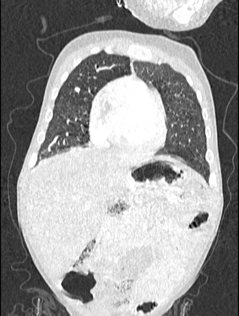 Asplenia syndrome (Radiopaedia 73083-83792 Coronal lung window 34).jpg