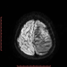 Astroblastoma (Radiopaedia 74287-85162 Axial DWI 94).jpg