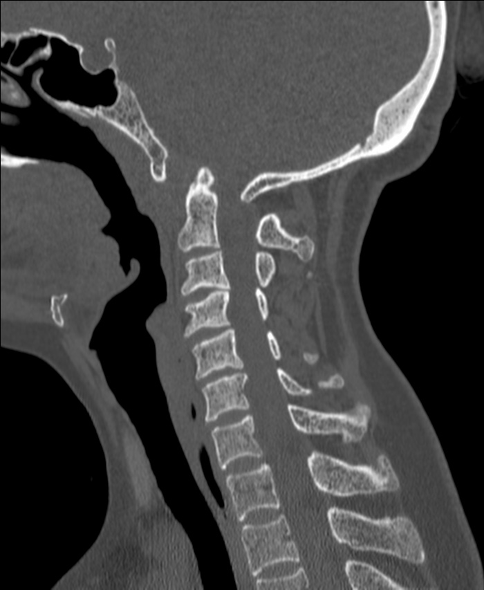 Atlanto-occipital assimilation with basilar invagination (Radiopaedia 70122-80188 Sagittal bone window 74).jpg