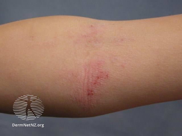 File:Atopic dermatitis (DermNet NZ dermatitis-flexural-eczema07).jpg