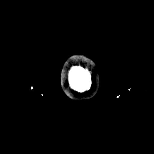 Atretic cephalocele (Radiopaedia 89782-106881 Axial non-contrast 191).jpg