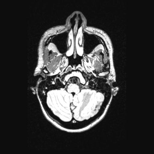Atretic encephalocoele with inferior vermis hypoplasia (Radiopaedia 30443-31108 Axial 34).jpg