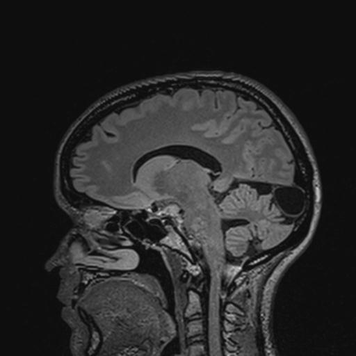 Atretic encephalocoele with inferior vermis hypoplasia (Radiopaedia 30443-31108 Sagittal FLAIR 91).jpg