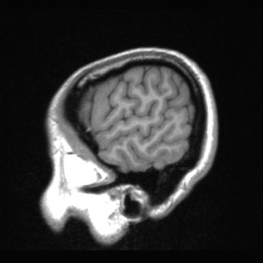 File:Atretic encephalocoele with inferior vermis hypoplasia (Radiopaedia 30443-31108 Sagittal T1 11).jpg