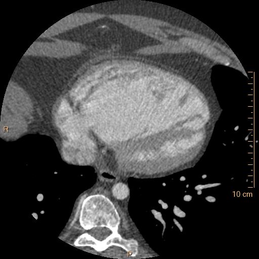 File:Atrial septal defect (upper sinus venosus type) with partial anomalous pulmonary venous return into superior vena cava (Radiopaedia 73228-83961 A 211).jpg