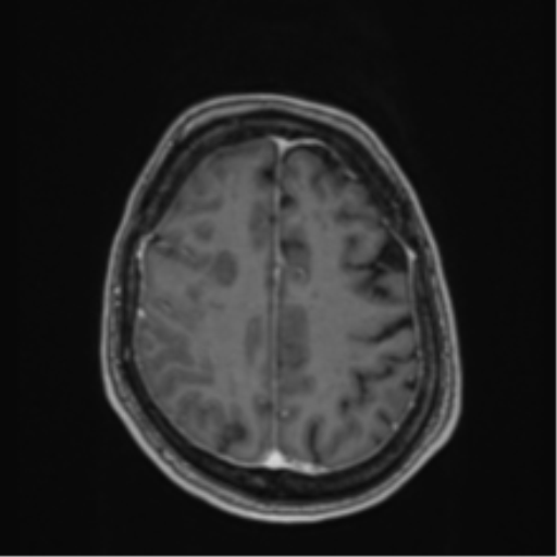 Atypical meningioma (WHO Grade II) (Radiopaedia 54742-60979 Axial T1 C+ 50).png