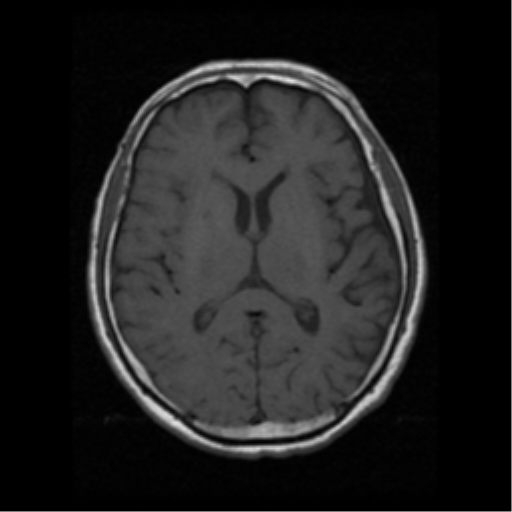 File:Atypical meningioma (WHO grade II) with osseous invasion (Radiopaedia 53654-59716 Axial T1 12).png