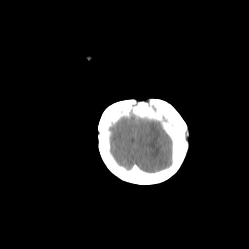 Atypical teratoid rhabdoid tumor (AT-RT) (Radiopaedia 85823-101654 Coronal non-contrast 53).jpg