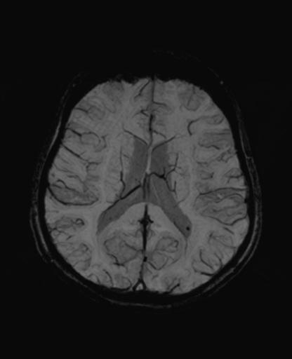 Autoimmune limbic encephalitis (Radiopaedia 30363-31005 SWI - mIP 44).jpg