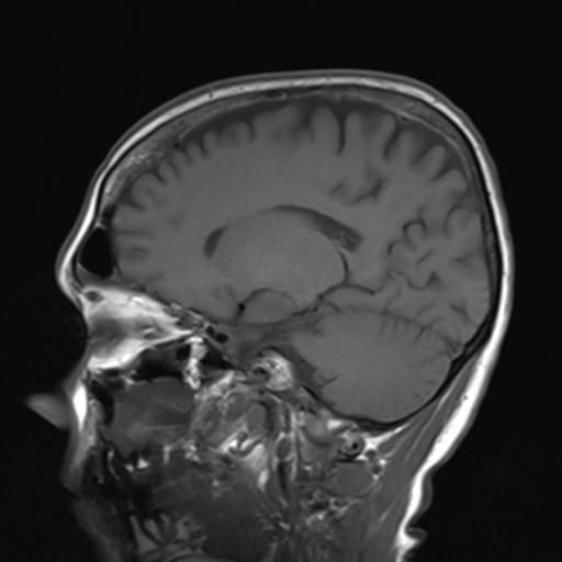 File:Autoimmune limbic encephalitis (Radiopaedia 30363-31005 Sagittal T1 16).jpg