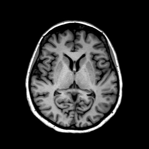 Autoimmune limbic encephalitis (Radiopaedia 30363-31005 T1 Axial 1mm 81).jpg