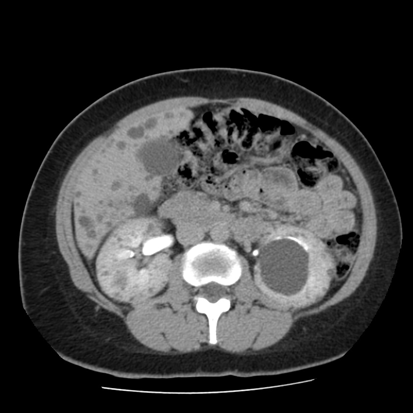 Autosomal dominant polycystic kidney disease (Radiopaedia 23061-23093 C+ delayed 31).jpg