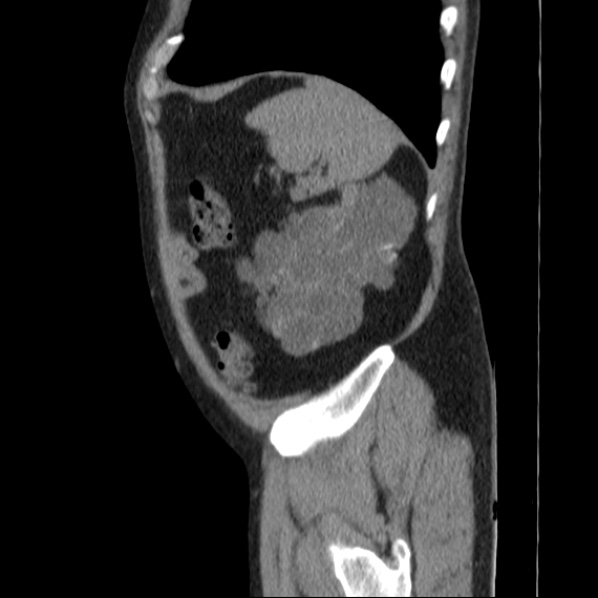 Autosomal dominant polycystic kidney disease (Radiopaedia 36539-38101 D 70).jpg