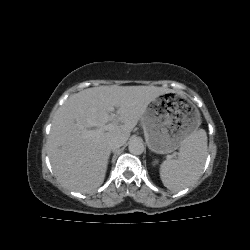 File:Autosomal dominant polycystic kidney disease (Radiopaedia 38189-40194 Axial C+ delayed 8).jpg