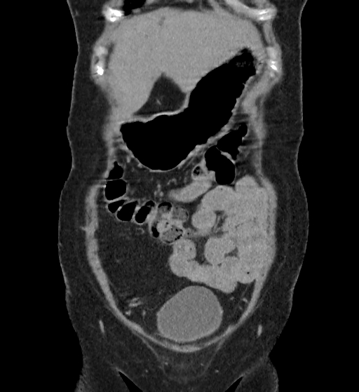 Autosomal dominant polycystic kidney disease (Radiopaedia 38189-40194 Coronal C+ delayed 5).jpg