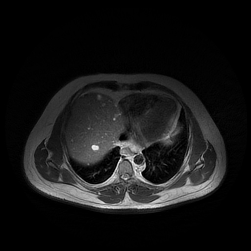 File:Autosomal dominant polycystic kidney disease (Radiopaedia 50259-55611 Axial T2 4).jpg
