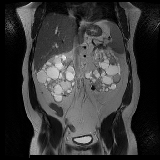 File:Autosomal dominant polycystic kidney disease (Radiopaedia 50259-55611 Coronal T2 19).jpg