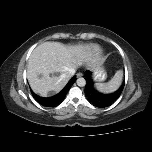 File:Autosomal dominant polycystic kidney disease with hepatic involvement (Radiopaedia 32693-33662 B 9).jpg