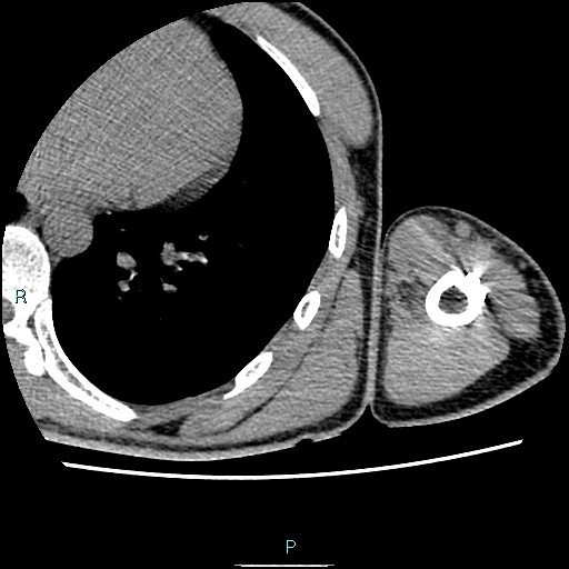 File:Avascular necrosis after fracture dislocations of the proximal humerus (Radiopaedia 88078-104653 D 91).jpg