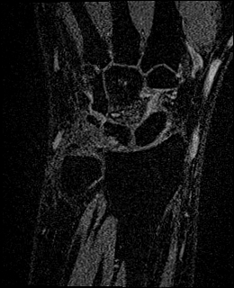 Avascular necrosis of the capitate (Radiopaedia 88317-104948 Coronal T1 vibe 24).jpg
