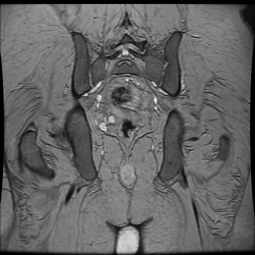 Avascular necrosis of the hip (Radiopaedia 61503-69465 F 78).jpg