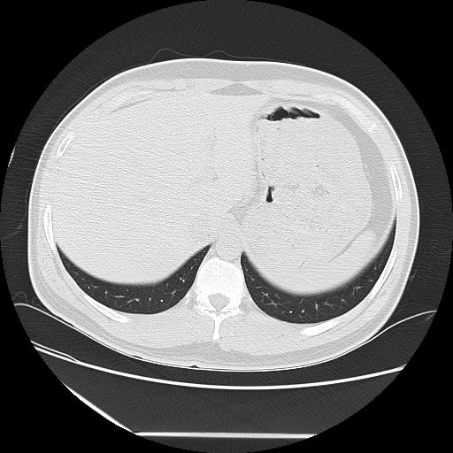 Azygos fissure (Radiopaedia 88181-104784 Axial lung window 51).jpg