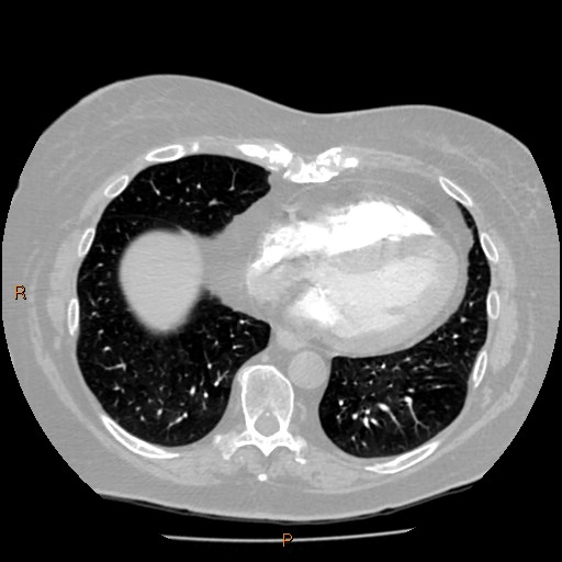 Azygos lobe (Radiopaedia 40161-42821 Axial lung window 52).jpg