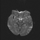 Balo concentric sclerosis (Radiopaedia 50458-55940 Axial DWI 36).jpg