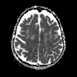 File:Balo concentric sclerosis (Radiopaedia 53875-59982 Axial ADC 18).jpg