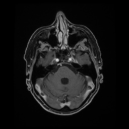 Balo concentric sclerosis (Radiopaedia 53875-59982 Axial LAVA C+ 75).jpg