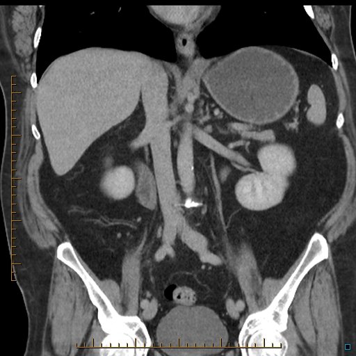 File:Bariatric balloon causing gastric outlet obstruction (Radiopaedia 54449-60672 B 33).jpg