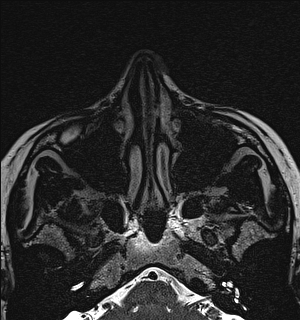 Basal cell carcinoma - nasal region (Radiopaedia 70292-80365 Axial Gradient Echo 30).jpg