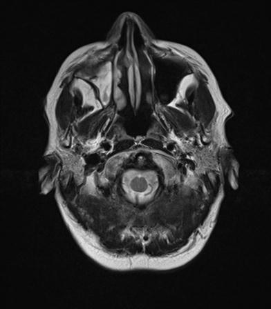 File:Base of skull chondrosarcoma (Radiopaedia 30410-31070 Axial T2 2).jpg