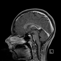 Base of skull rhabdomyosarcoma (Radiopaedia 32196-33142 J 33).jpg