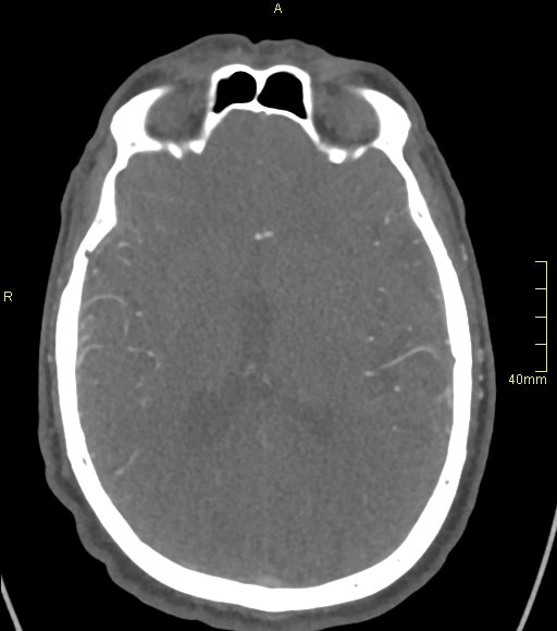 Basilar artery aneurysm (Radiopaedia 56261-62932 A 86).jpg