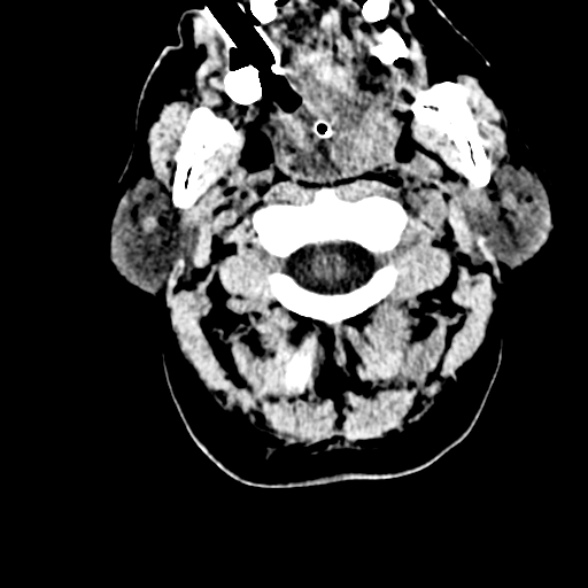 Basilar artery thrombosis (Radiopaedia 53351-59352 Axial non-contrast 9).jpg