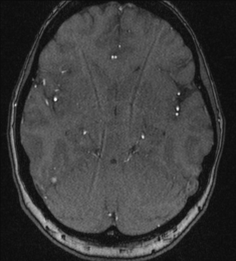 Basilar tip aneurysm (Radiopaedia 26504-26632 MRA 96).jpg