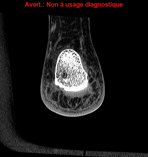 File:Baxter neuropathy (Radiopaedia 25988-26125 Coronal non-contrast 47).jpg