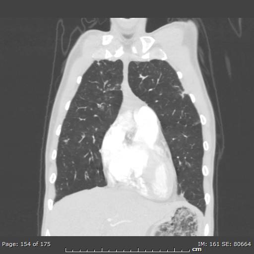 File:Behçet disease (Radiopaedia 44247-47889 Coronal lung window 49).jpg