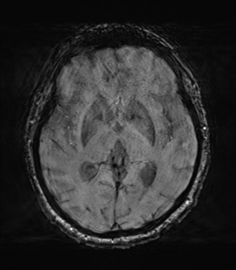 File:Behavioral variant frontotemporal dementia and late onset schizophrenia (Radiopaedia 52197-58083 Axial SWI 36).png