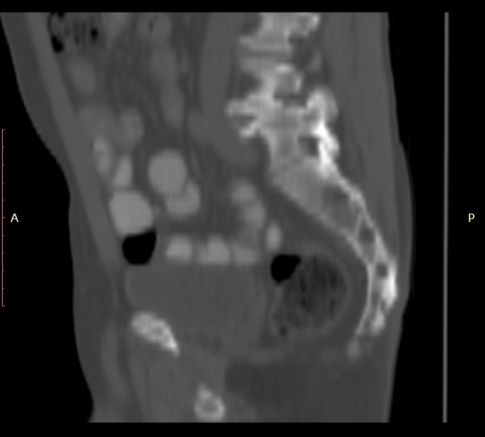 Bertolotti syndrome (Radiopaedia 58974-66235 Sagittal bone window 15).jpg