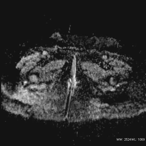 File:Bicornuate uterus- on MRI (Radiopaedia 49206-54297 Axial ADC 25).jpg