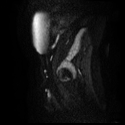 File:Bicornuate uterus (Radiopaedia 51676-57472 Sagittal DWI 27).jpg