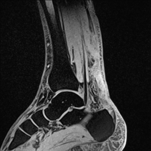 Bilateral Achilles tendon complete tear (Radiopaedia 81344-95051 Sagittal WE - Left 50).jpg