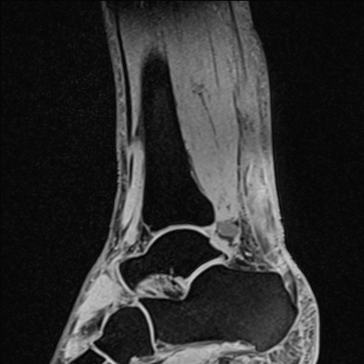 Bilateral Achilles tendon complete tear (Radiopaedia 81344-95051 Sagittal WE - Right 48).jpg